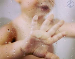 Hard water eczema
